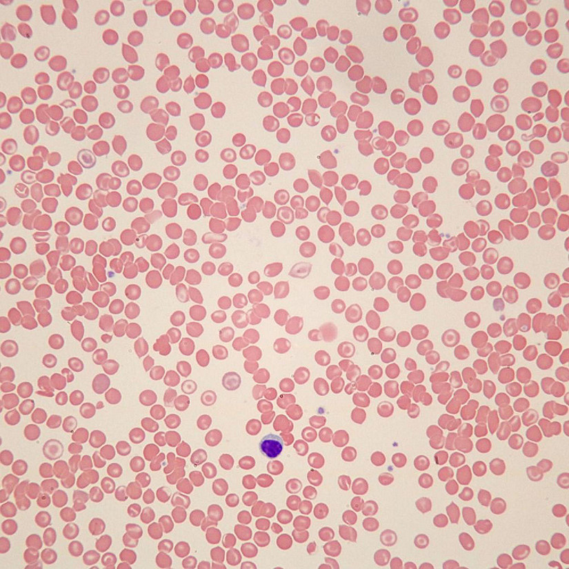 Carolina Biological Supply Company Human Sickle Cell Anemia Slide, Smear, Wright's Stain Image