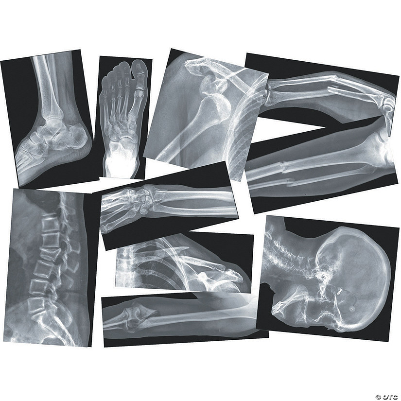 Roylco Broken Bones X-Rays Image