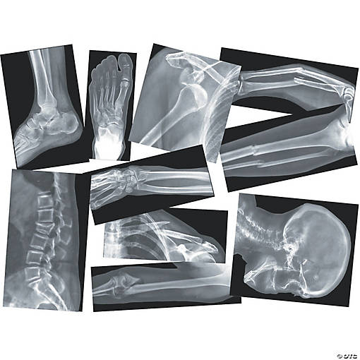 Roylco Broken Bones X-Rays